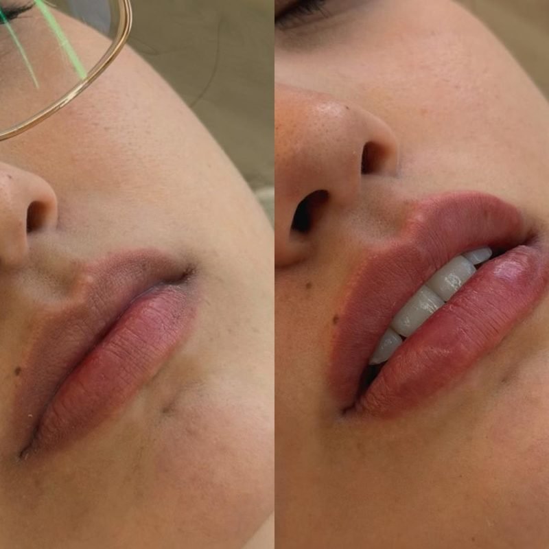 Antes e depois de preenchimento labial de paciente da Dra. Amanda Vitorino