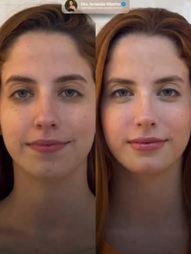 Antes e depois de harmonização facial de paciente, publicado com autorização